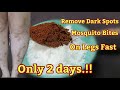 Remove Dark Spots, Mosquito Bites, Scar, Hyperpigmentation On Legs Fast Only 2 days.!!