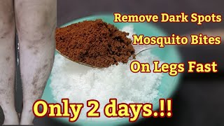 Remove Dark Spots, Mosquito Bites, Scar, Hyperpigmentation On Legs Fast Only 2 days.!!