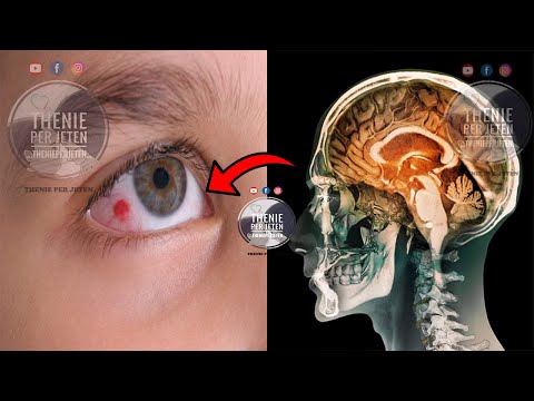 Nëse u ndodh shpesh qe ju shfaqen njolla të kuqe në sy, këtë duhet ta dini me patjeter