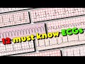 ECG Rhythms Every Medical Professional Must Know