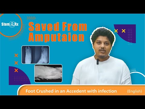 Mauritius Boy almost lost Leg in Accident |StemRx Regenerative Therapy Saved his Leg from Amputation