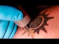 How Laser Tattoo Removal Works - Smarter Every ...