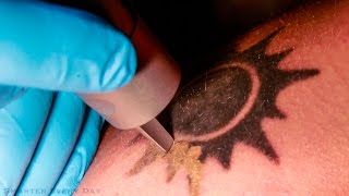 Como funciona a remoção de tatuagem a laser