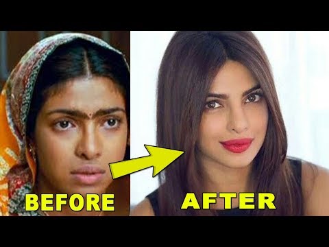download lagu mp3 mp4 Priyanka Chopra Lip Surgery, download lagu Priyanka Chopra Lip Surgery gratis, unduh video klip Priyanka Chopra Lip Surgery
