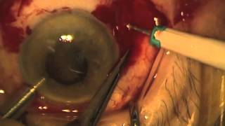 CHOROIDAL DRAINAGE Final.m4v