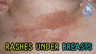 Home remedies to treat the rashes under the breasts