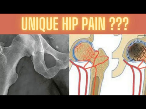 Avascular Hip Necrosis : How it causes hip pain & a nonsurgical treatment option