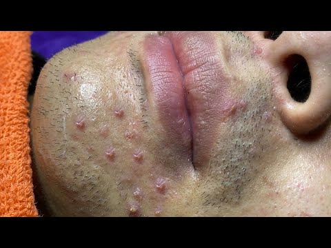 Loan Nguyen Acne Treatment (#117)