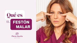 Festón malar - Clínica Dra. Pérez Sevilla
