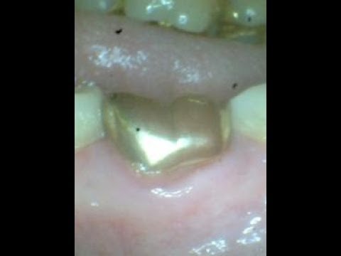 zahnfleisch von zahnkrone gepreßt?