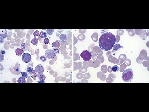 Anämie bei Kupfermangel