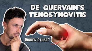 The HIDDEN Cause of De Quervain's Tenosynovitis
