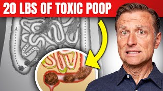 Do We REALLY Have 5 to 20 lbs of Toxic Poop in Our Colons?