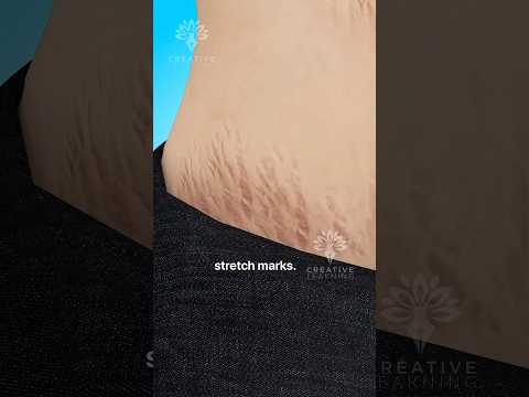 Why Do Stretch Marks Really Happen 😱 #shorts #viralvideo - Creativelearning3d