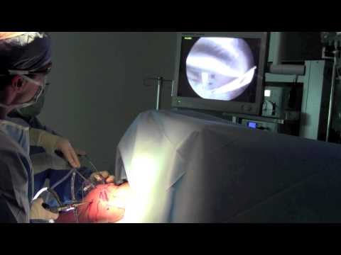 Arthroscopic Rotator Cuff Repair