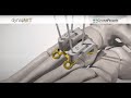 dynamet™ lesser tmt fusion system surgical technique