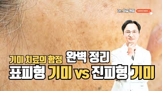 黄褐斑治疗的陷阱——表皮型 vs 真皮型黄褐斑全解析