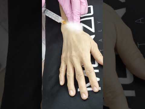 Sculptra Hand Rejuvenation | Restore Youthful Volume 