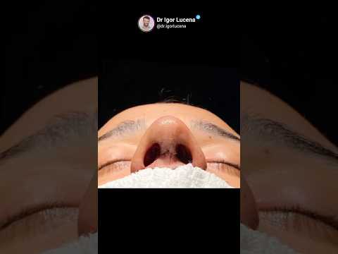 Rinoplastia #drigorlucena #consultaonline #rinoplastiabahia #rinoplastiabrasil