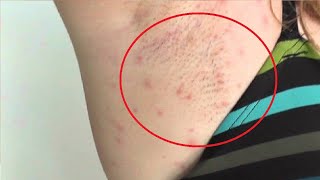 how to get rid of armpit razor bumps