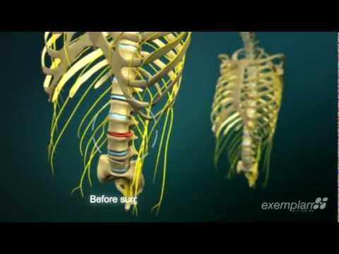 LumberDiscectomy 2 5