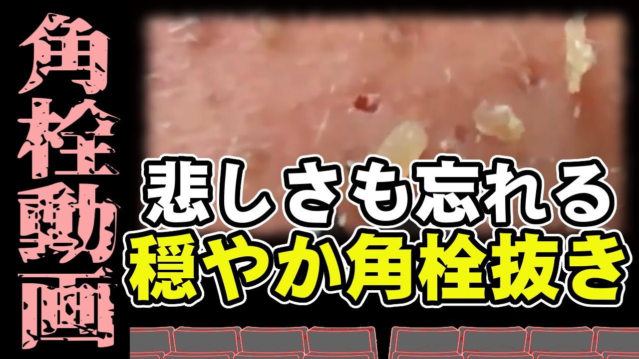 【 角栓抜き動画 】悲しさも忘れる穏やかな角栓抜き動画～A gentle blackhead removal video that will make you forget your sadness