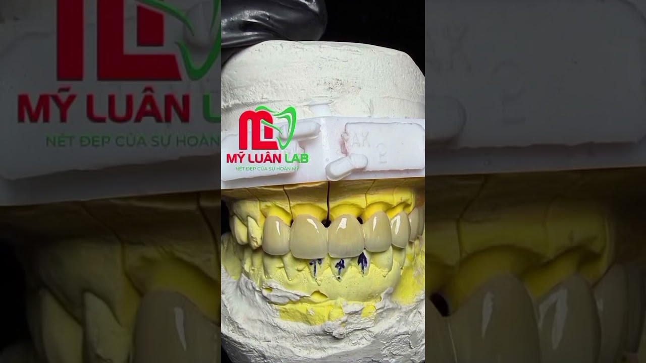 Mỹ Luân Dental Lab - Đối tác tin cậy cho những ca răng sứ thẩm mỹ chất lượng