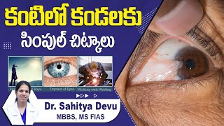 కంటిలో కండలకు || Pterygium Prevention and Treatment || Swollen Eyes || Best Vision Eye Hospital