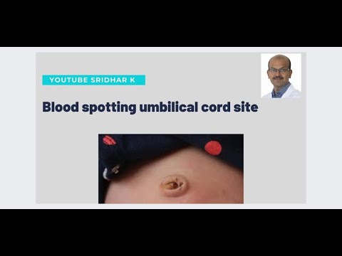 What to do if there is blood spotting at umbilical cord site? Dr Sridhar