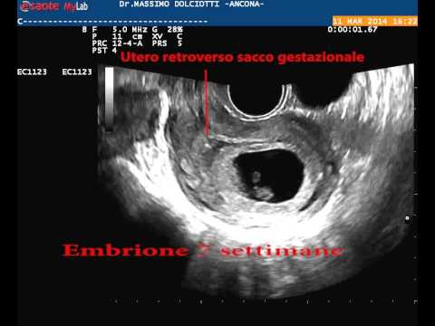 Borsite del trattamento del ginocchio Photo Ostenil nellarticolazione del ginocchio