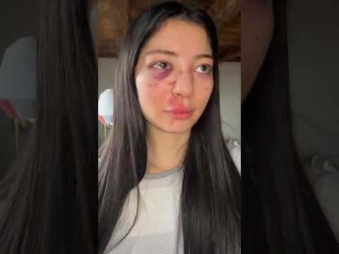 Ich mache den Trend nochmal wenn mein Gesicht geheilt ist😭