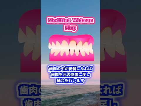 生命歯学科 歯周外科手術　Modified Widman Flap法について解説します！　#shorts  #歯周外科　＃歯周病　＃歯を抜かない　＃歯を残す
