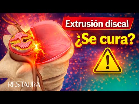 xtrusión discal: ¿se cura o siempre necesita cirugía?