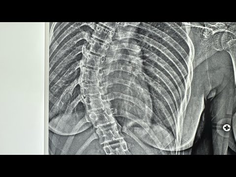 Scoliosis in 13 year old girl : symptoms diagnosis treatment