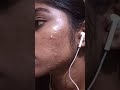 My Pimple Transformation Within 3 Months Missnithya