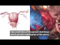 Obstetrical Hemorrhage from Placenta Accreta: Saving Lives with Cesarean Hysterectomy | Stanford