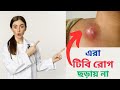 Not Every TB Patient Spread Tb Disease সবাই টিবি রোগ ছড়ায় না