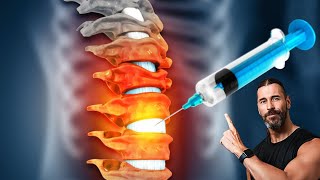 Spine Injection for Chronic Back Pain | My Recovery, Results & What I Learned