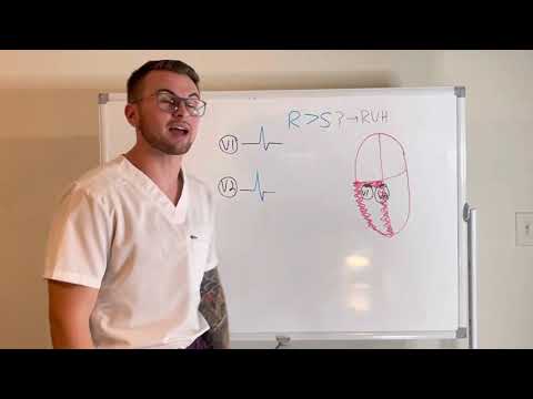 EKG Series: Right Ventricular Hypertrophy Criteria