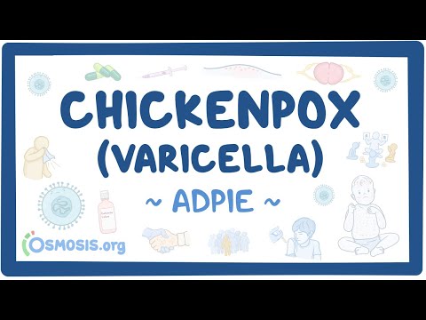 Chickenpox (Varicella): Nursing Process (ADPIE)