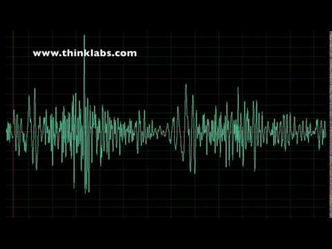 Systolic Ejection Murmur from AV Dialysis Fistula