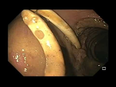 Colon, condición benigna, perforación de drenaje del colon transversal