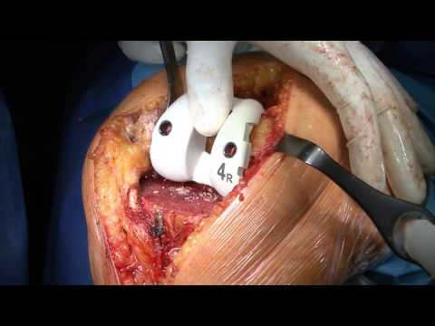 Osteocondrosi della colonna cervicale nel trattamento di vitamine del gruppo B Rispetto alle persone trattano le articolazioni
