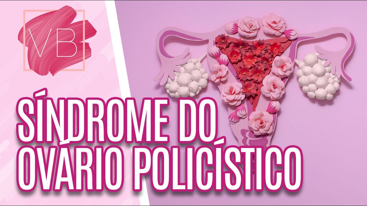 Síndrome do ovário policístico - Você Bonita (16/09/20)