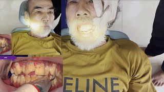 sử lý răng vỡ khi ăn đồ cứng bệnh nhân đau nhức