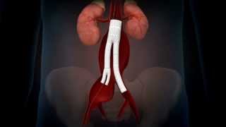 EpicMM_IliacStents_05_H264