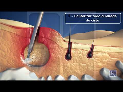 EPSIT — Tratamento Endoscópico do Cisto Pilonidal