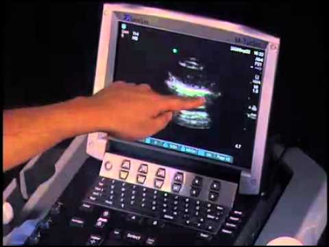 How to: Pneumothorax Evaluation with Ultrasound