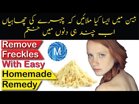 How To Get Rid Of Freckles With Easy Home Remedy ||...