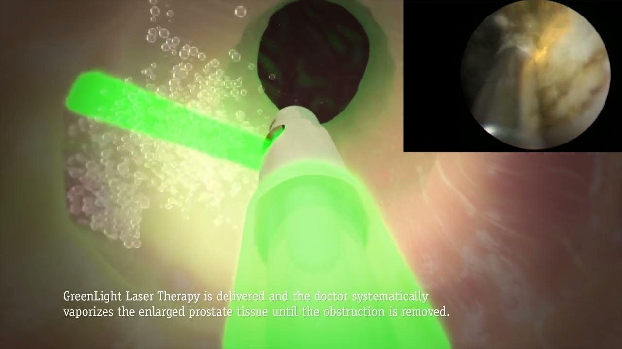 GreenLight for BPH Procedure Animation